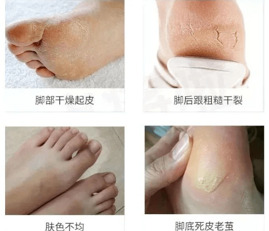 痛快“撕”脚皮，剥脱废弃角质，嫩肤滋养