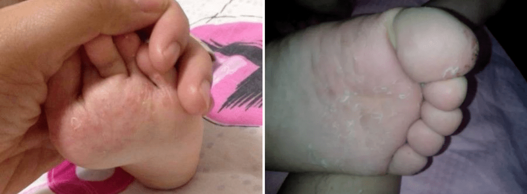 痛快“撕”脚皮，剥脱废弃角质，嫩肤滋养