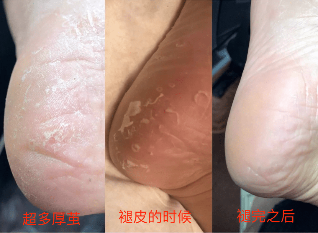 痛快“撕”脚皮，剥脱废弃角质，嫩肤滋养