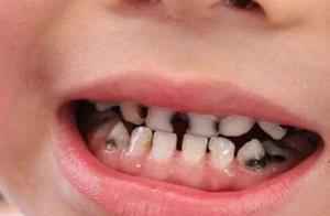 儿童蛀牙口腔保险也能报销？