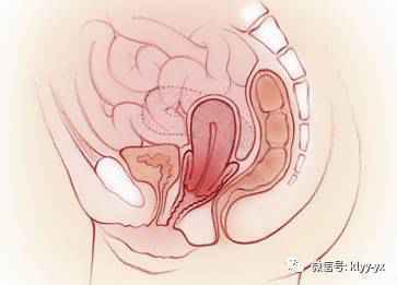 产后子宫都掉下来了，你还傻傻地不知道